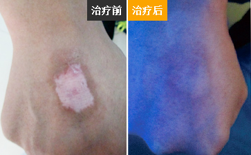 得了白癜风病能治好吗