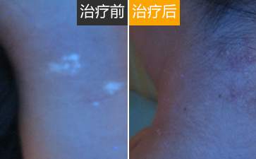 颈部白癜风如何治疗