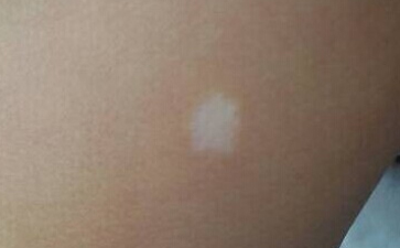 白癜风在发病后有什么表现