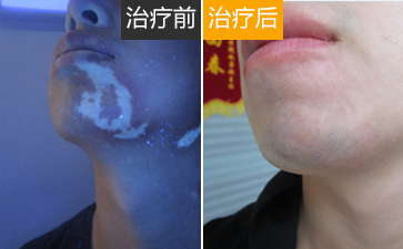 应该如何控制白癜风