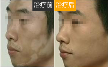 白癜风的发病原因有哪些