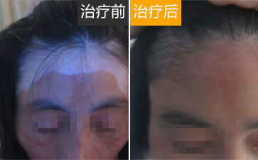 白癜风治疗误区有什么